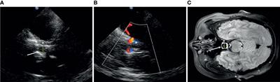 Transcranial Sonography in the Diagnosis of Pituitary Tumor—A Direct Comparison With MRI